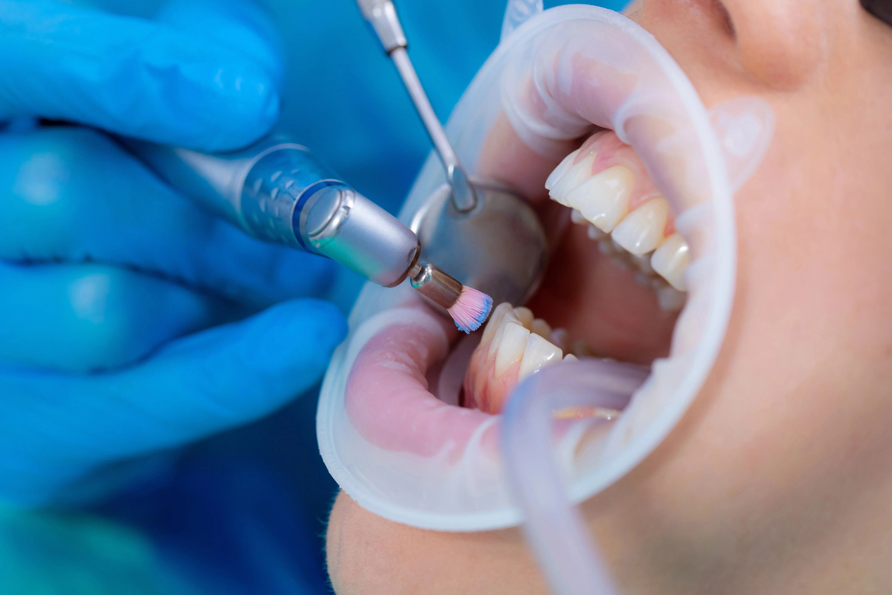 Профессиональная чистка зубов ClinPro в стоматологической клинике 