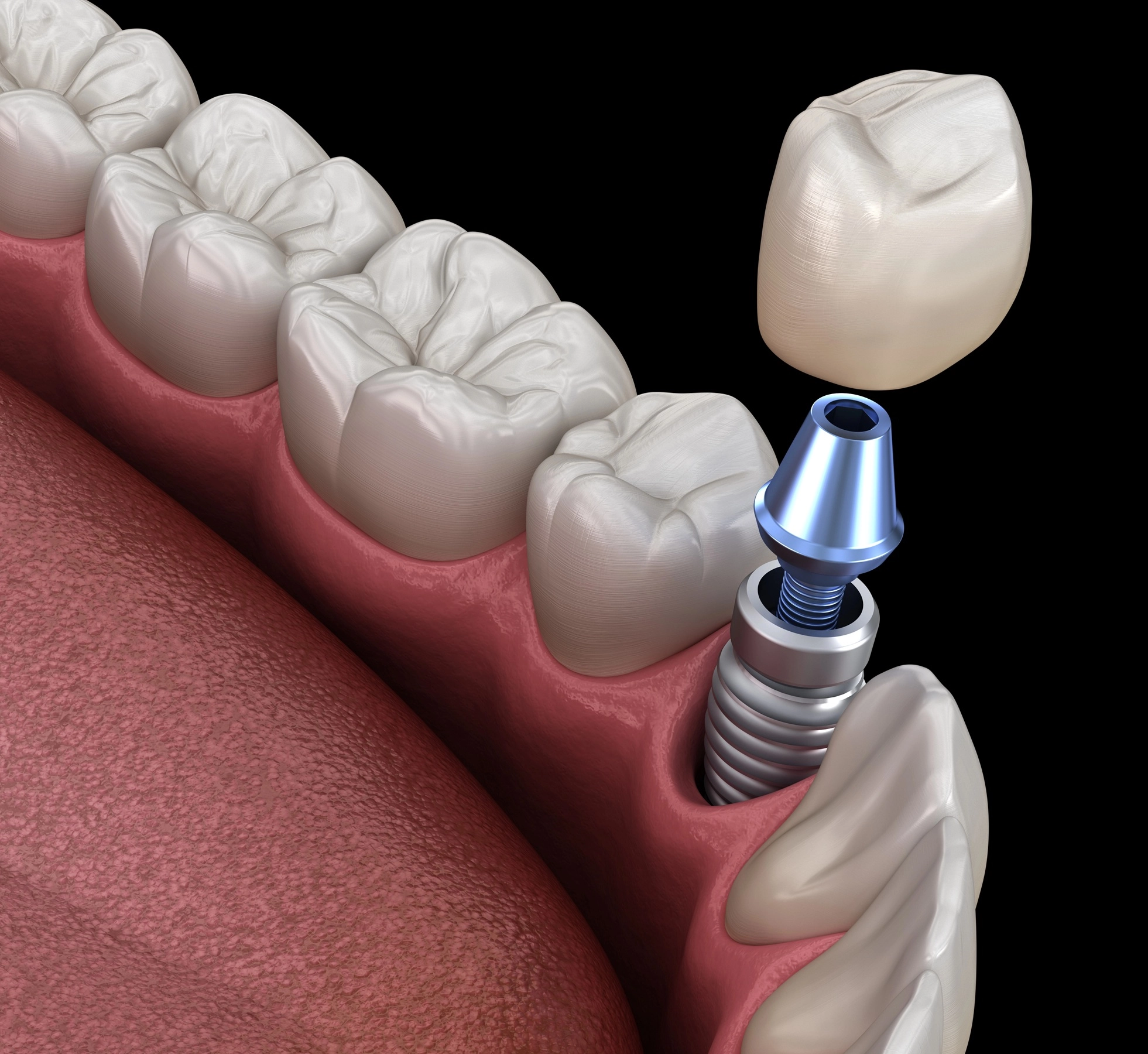 Установка имплантов Dentium в стоматологической клинике 